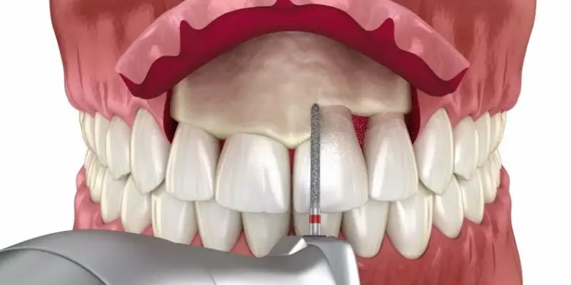 تفاوت جراحی لثه با جرم گیری عمیق 