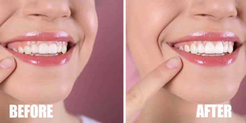 مراقبت های بعد از جراحی لثه