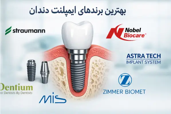 بهترین برند ایمپلنت دندان در ایران کدام است؟