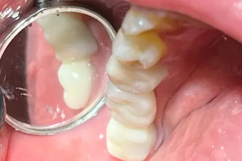 جراحی زیبایی لثه با قیمت مناسب در تهران