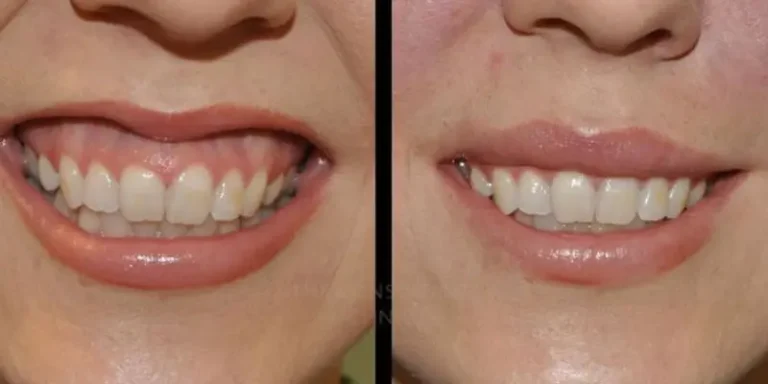مراقبت های بعد از جراحی لثه